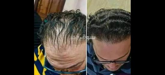 زيت تطويل الشعر وعلاج التقصف - 2