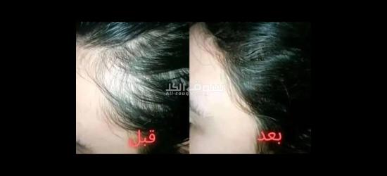 زيت تطويل الشعر وعلاج التقصف - 6